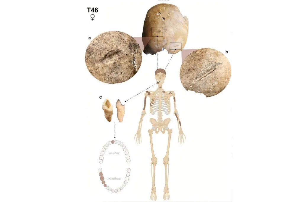 El esqueleto de T46 muestra las lesiones presentes en el cráneo y un desgaste dental inusual. Las zonas sombreadas indican los huesos que se conservaron